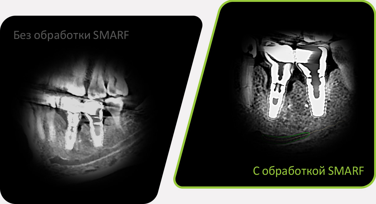 SMARF - алгоритм уменьшения вторичного улучшения от металлов дентального компьютерного 3D томографа