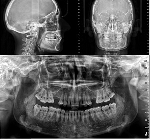 Стоматологический томограф NewTom Giano HR Advanced (13x16) с цефалостатом - Фото 7